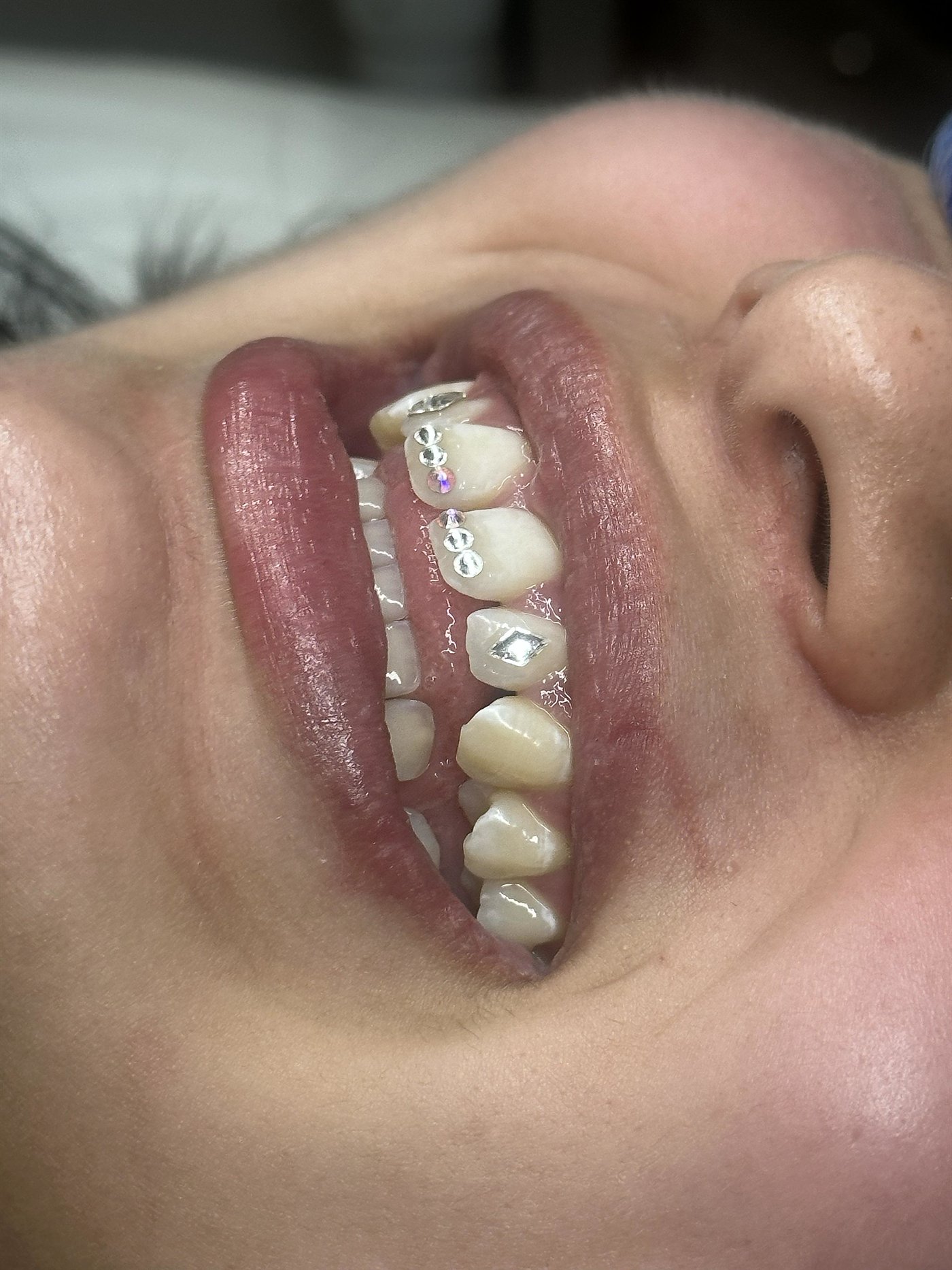 Professional tooth gem application with crystal accents on teeth